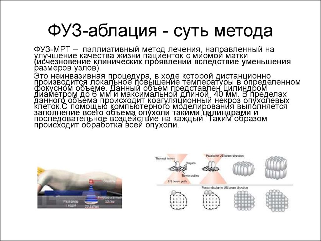 Суть метода. Фуз аблация миоматозных узлов. Суть метода фуз аблация. Мрт сущность метода.