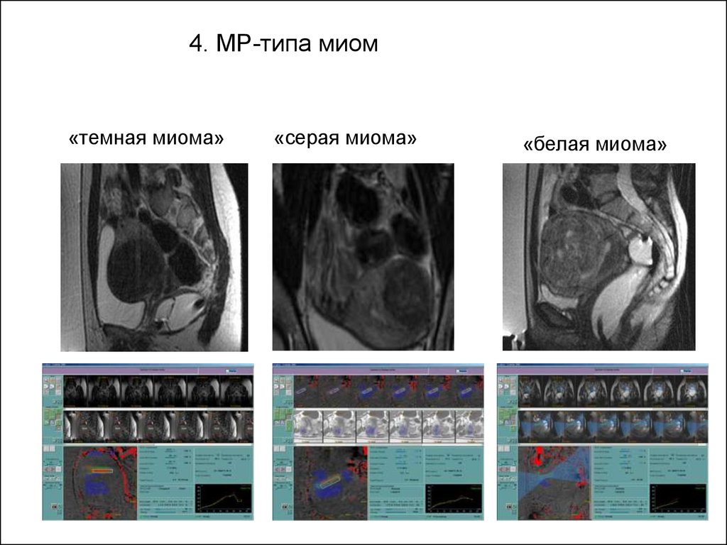 Типы миом. Миома матки мрт контрастирование. Субмукозная миома матки мрт.