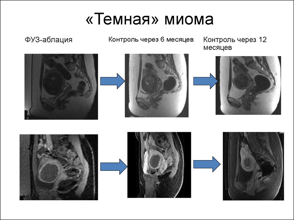 Как выглядит миома матки на мрт картинки