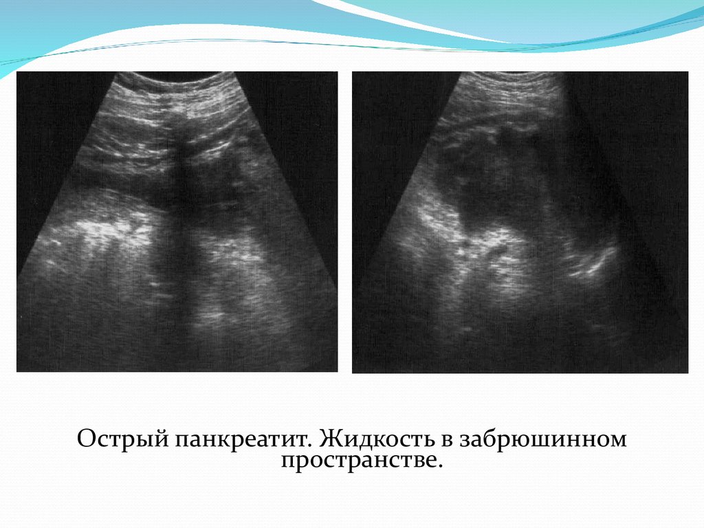 Узи забрюшинного пространства. Жидкость в забрюшинном пространстве на УЗИ. УЗИ поджелудочной железы острый панкреатит. Образования забрюшинного пространства на УЗИ. Панкреатит на УЗИ.