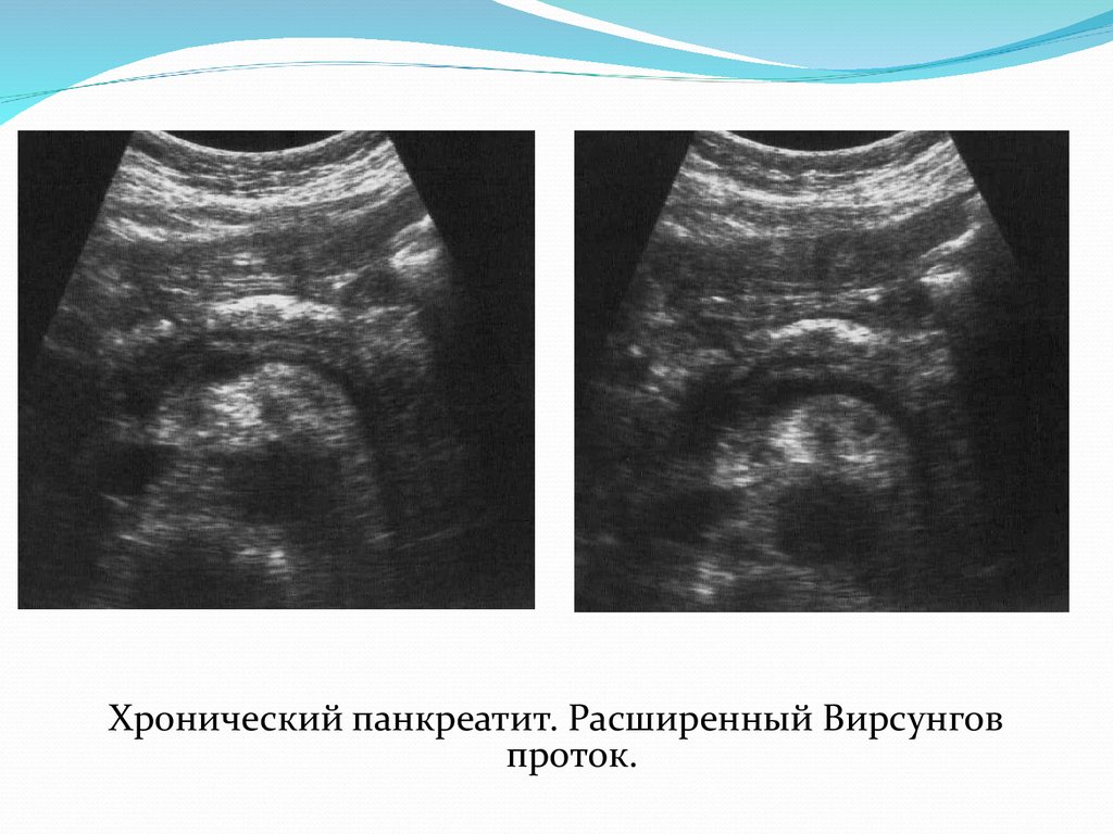 Расширения протоки. Расширение вирсунгова протока на УЗИ. Расширение вирсунгова протока поджелудочной железы на УЗИ. Вирсунгов проток на УЗИ норма. Вирсунгов проток поджелудочной железы норма.