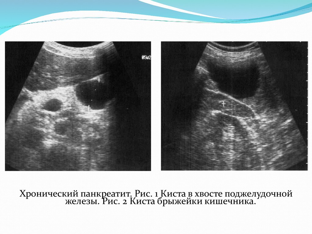 Поджелудочная железа киста. Кистозная опухоль поджелудочной железы на УЗИ. Кисты поджелудочной железы этиология. Псевдокисты поджелудочной железы на УЗИ.