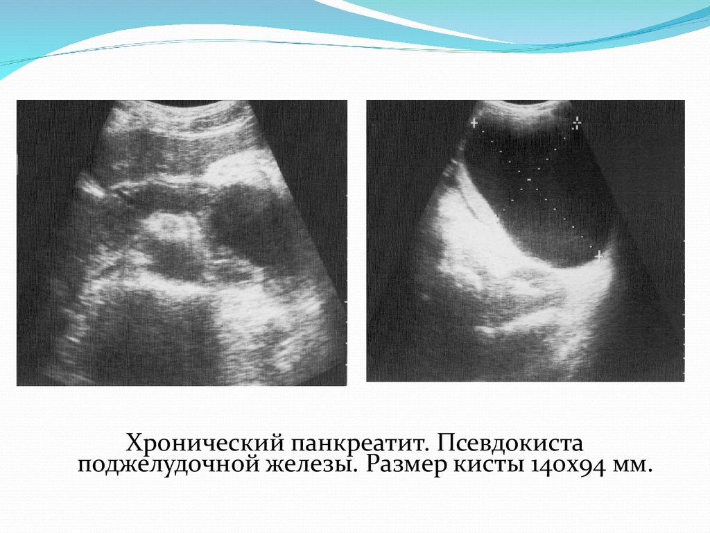 Узи поджелудочной железы. Псевдокиста поджелудочной железы на УЗИ. Кистозная опухоль поджелудочной железы на УЗИ. Острый панкреатит псевдокиста. Псевдокисты поджелудочной железы.