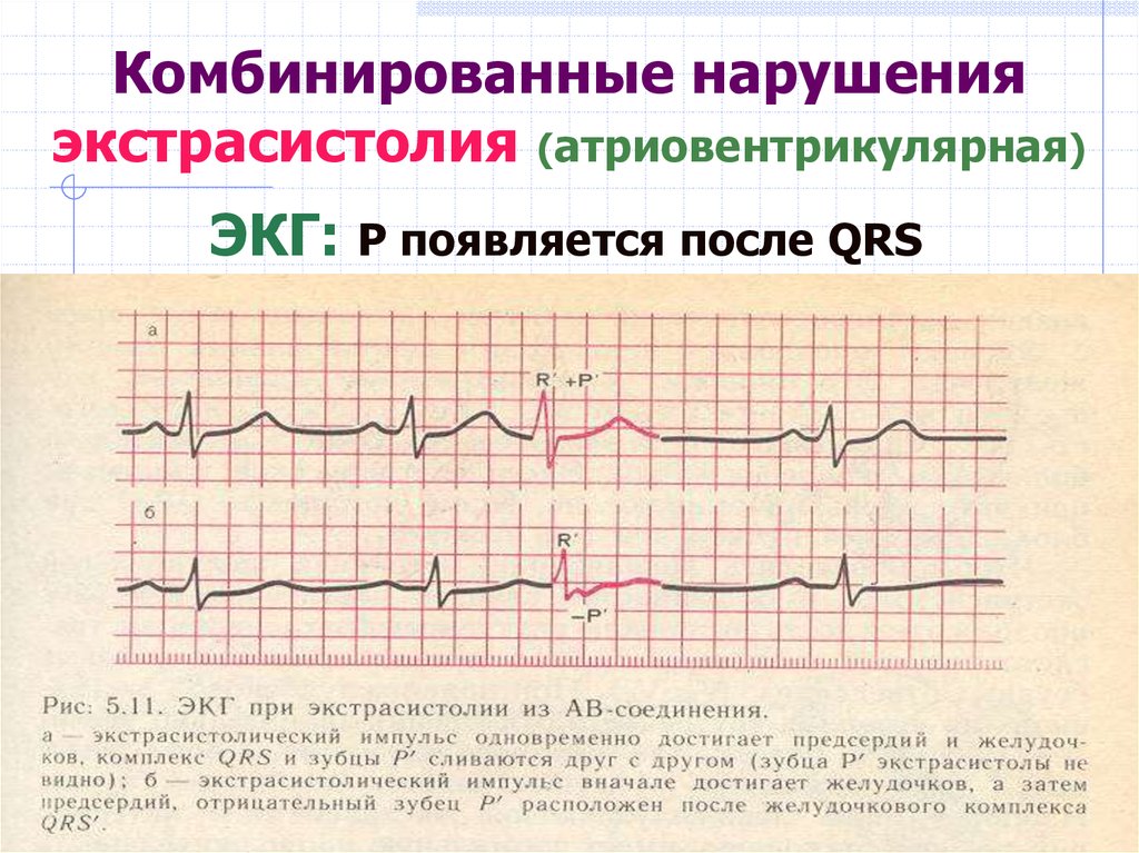 Как на экг выглядит экстрасистолия фото