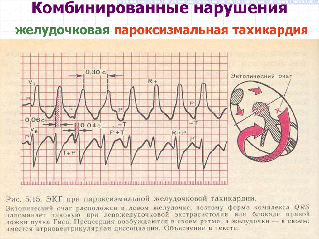 Экстрасистолия карта вызова