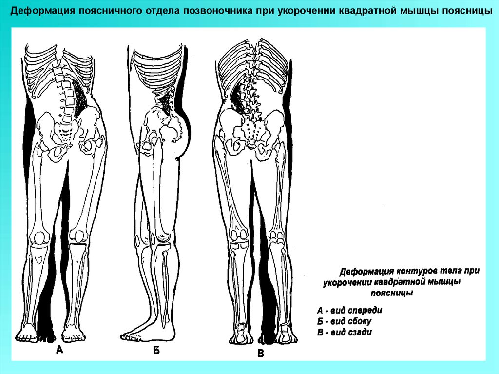 Квадратная поясница. Перекос таза и квадратная мышца поясницы. Укорочение подвздошно-поясничной мышцы одностороннее. Укорочение подвздошно-поясничной мышцы. Укорочение квадратной мышцы поясницы.