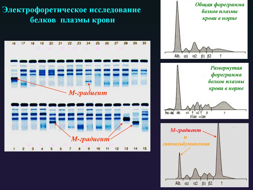 М градиент. М-градиент в крови норма. М-градиент электрофорез. М градиент протеинограмма.