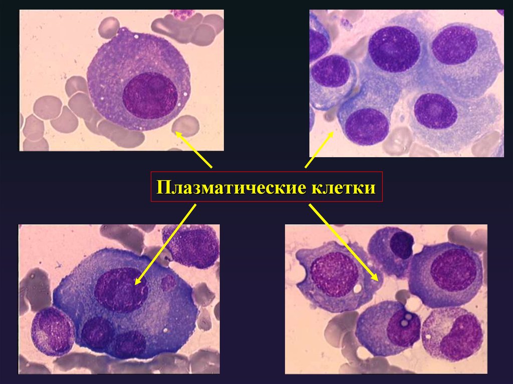 1 плазматическая клетка. Плазматические клетки микроскопия. Плазматические клетки плазмоциты. Плазматические клетки гистология. Плазматические клетки (плазмоциты) строение.