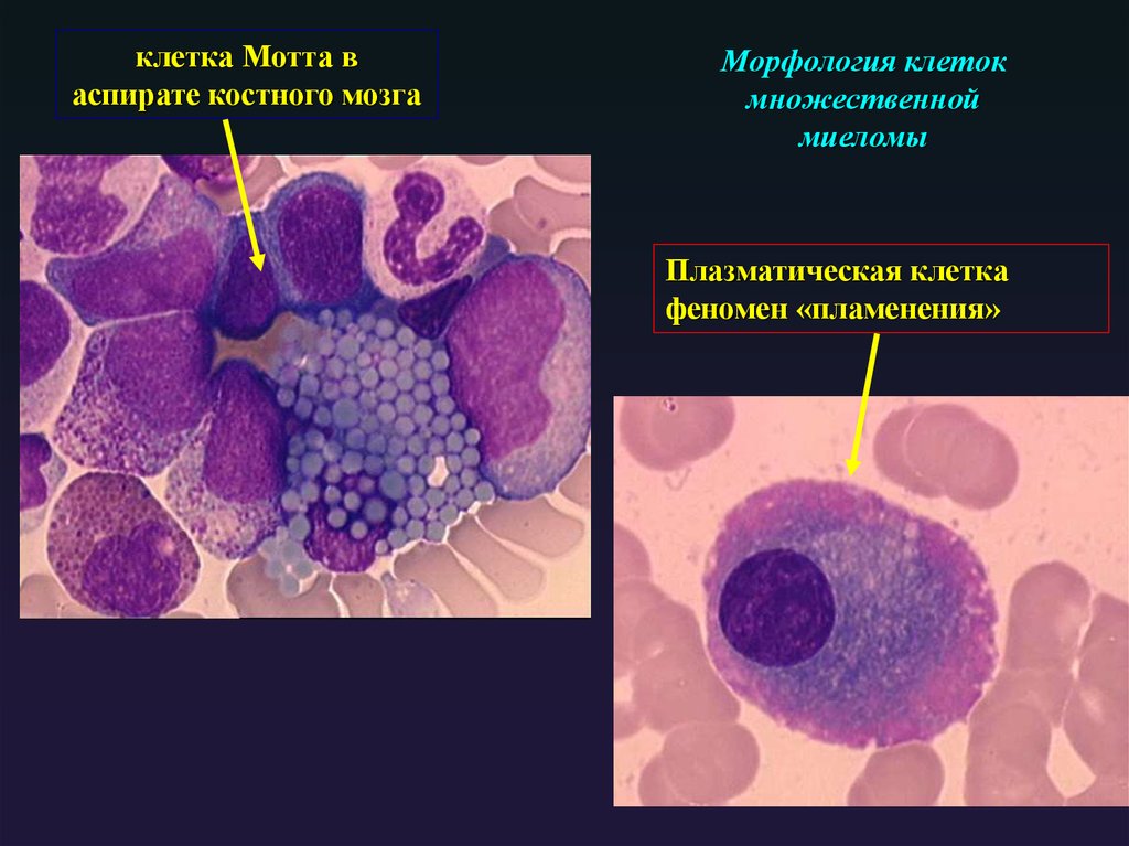 Миеломная болезнь костный мозг. Плазматические клетки плазмоциты. Множественная миелома плазматические клетки. Миеломная болезнь морфология.