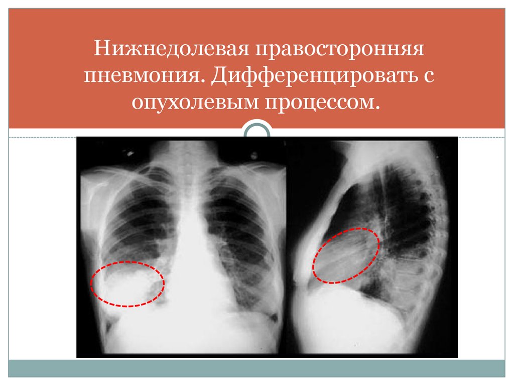 Сегментарная пневмония у детей что это