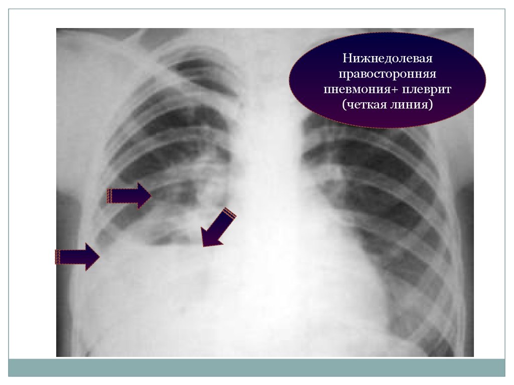 Правосторонняя пневмония. Правосторонняя нижнедолевая пневмония. Нижнедолевая пневмония рентген. Правосторонняя нижнедолевая пневмония рентген. Рентгенография при правосторонней нижнедолевой пневмонии.