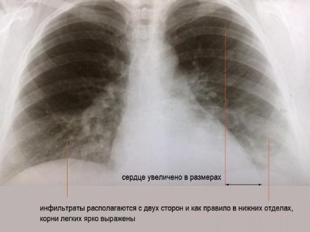 После пневмонии легочный рисунок усилен