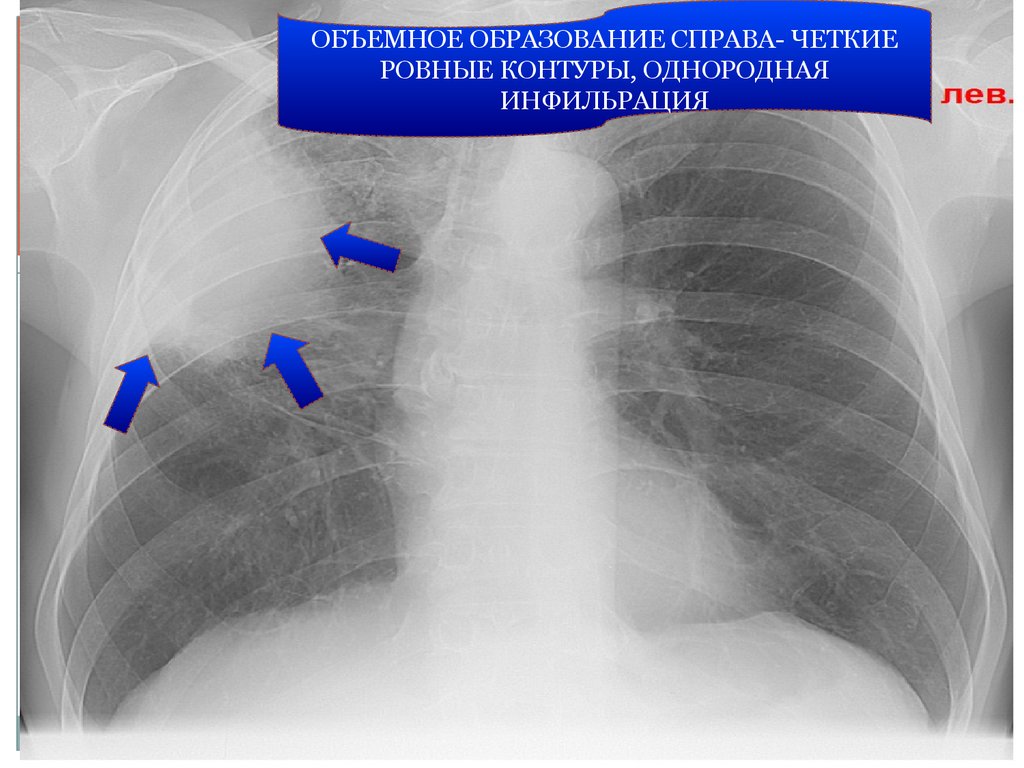 Образование в легких. Полицикличная тень с ровными контурами. Образование в легком. Справа без четких границ.