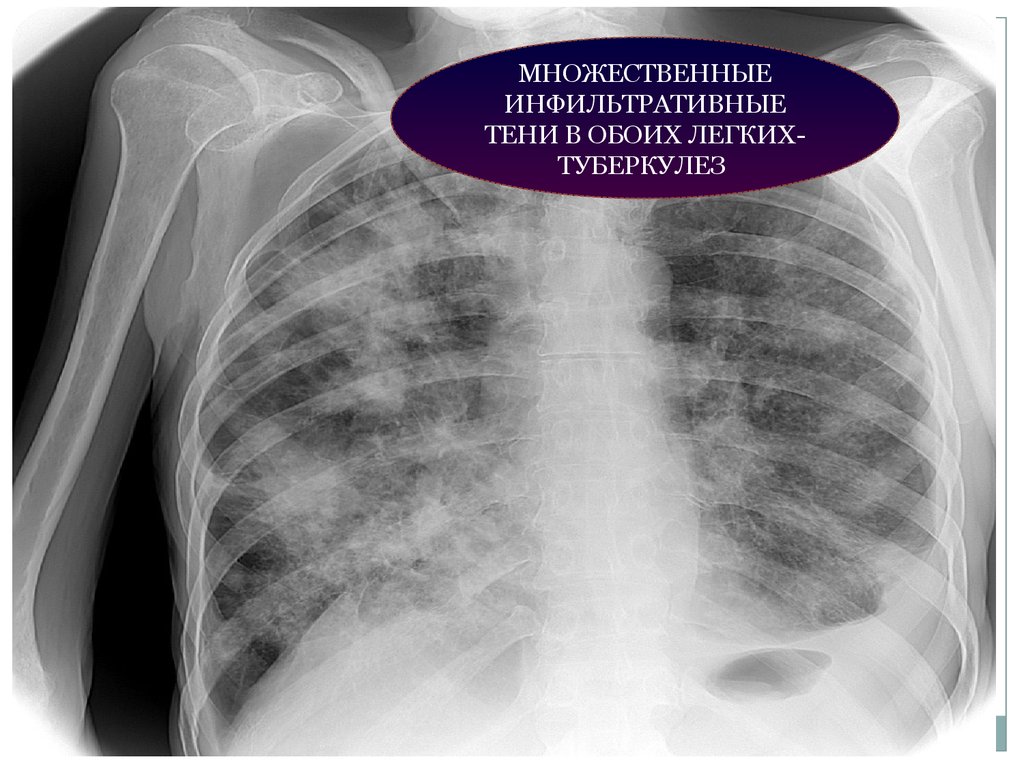 Рентгенография органов грудной клетки. Инфильтративные тени в легких что это. Инфильтративный туберкулез тень. Рентгенограмма грудной клетки туберкулез. Рентген грудной клетки туберкулез.