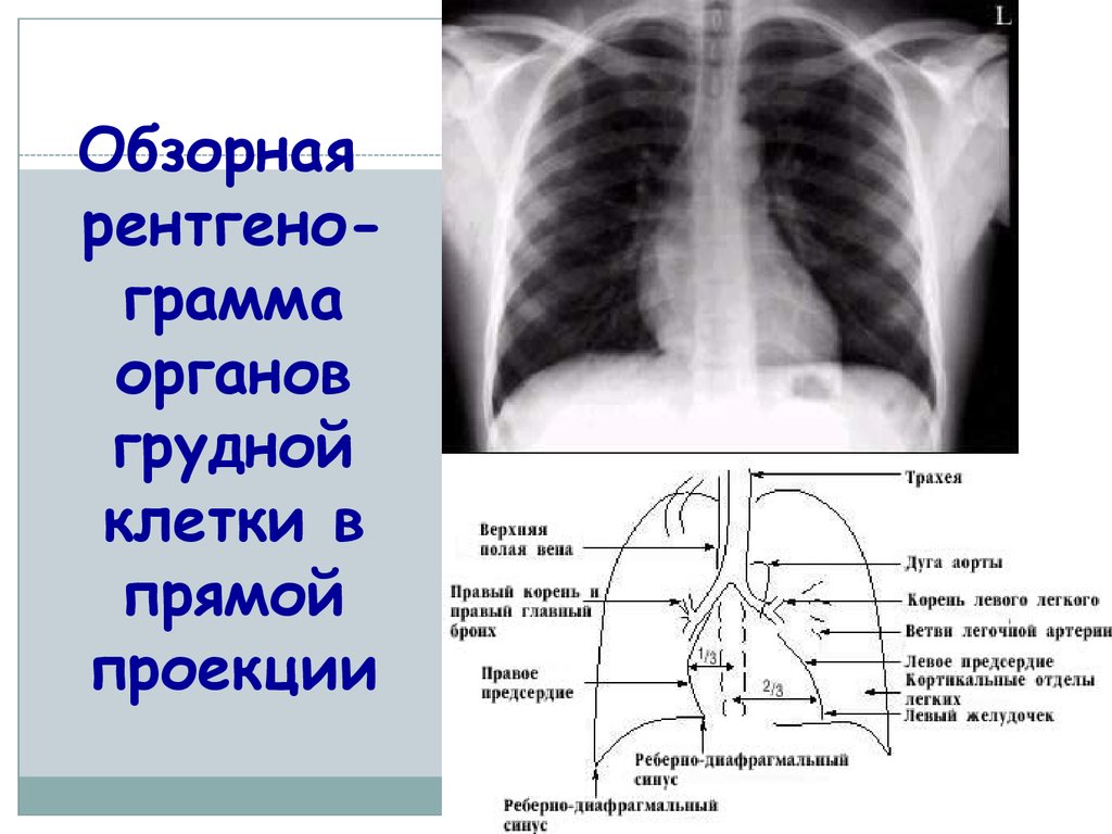 Синусы легких свободны. Рентген в 3 проекциях грудной клетки. Схема рентгенограммы грудной клетки в прямой проекции. Рентген грудной клетки в 2 проекциях. ФЛГ грудной клетки в 2 проекциях.