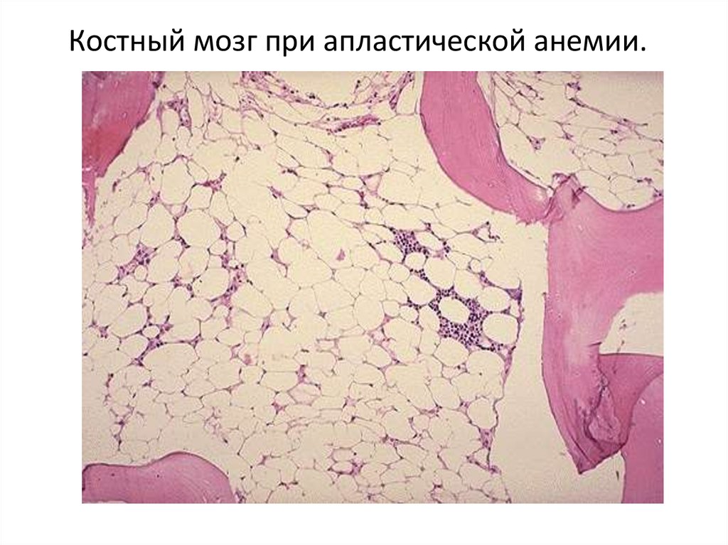 Опухоль костного мозга. Апластическая анемия трепанобиопсия. Костный мозг при апластической анемии. Апластическая анемия патанатомия. Апластическая анемия микропрепарат.