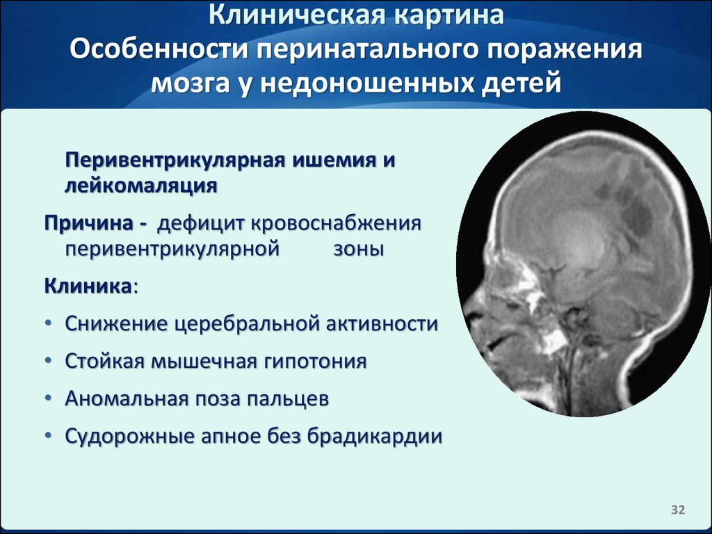 Резидуальное поражение головного