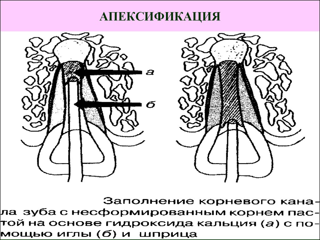 Апексогенез и апексификация. Апексификация методика проведения. Апексификация и апексогенез методики. Апексоыикация метрдика. Апексификация. Показания. Методика проведения..