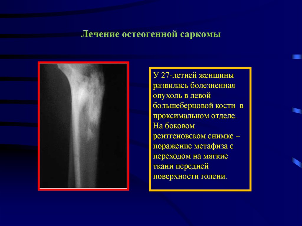 Виды сарком. Остеосаркома кости рентген. Саркомы костей рентген. Симптомы саркомы бедренной кости у детей. Опухоли бедренной кости на рентгенограммах.