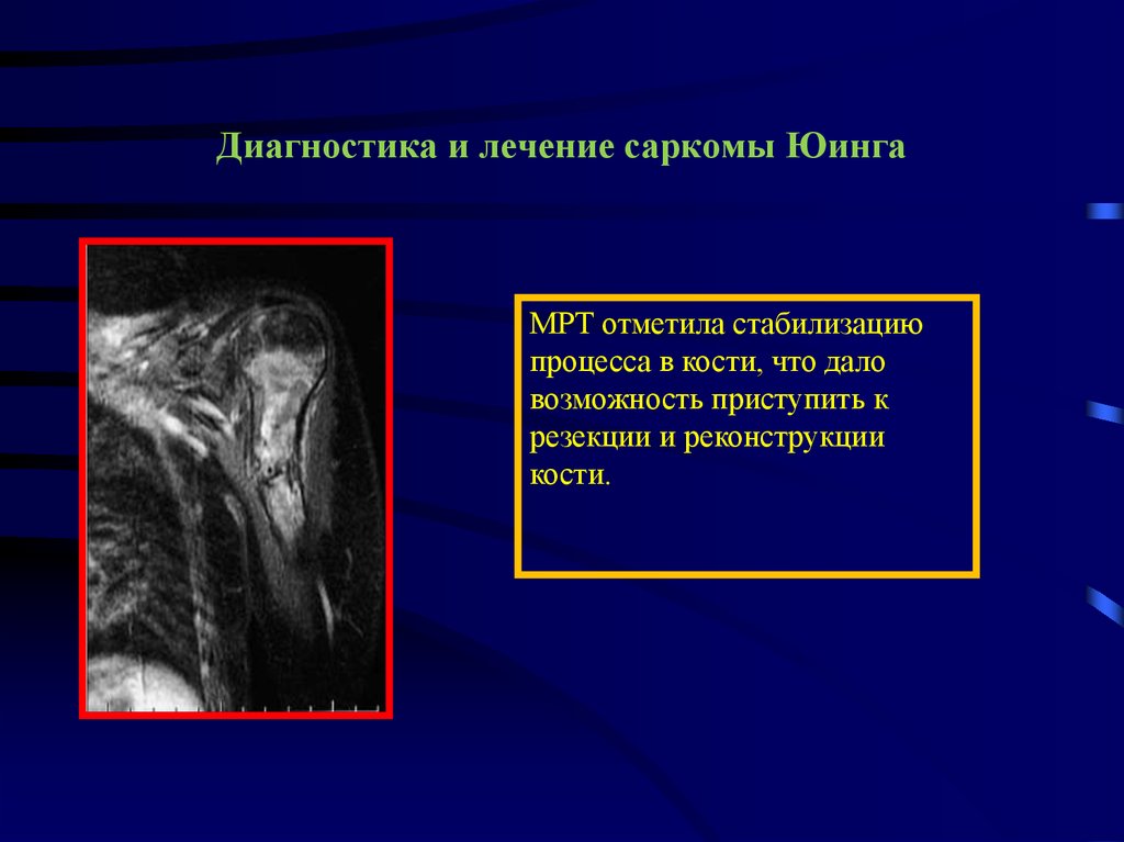 Опухоли костей презентация