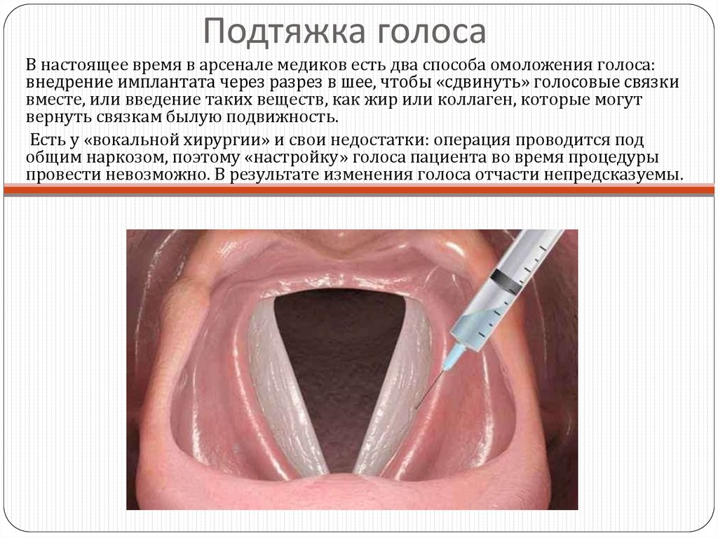 Подтяжка голоса