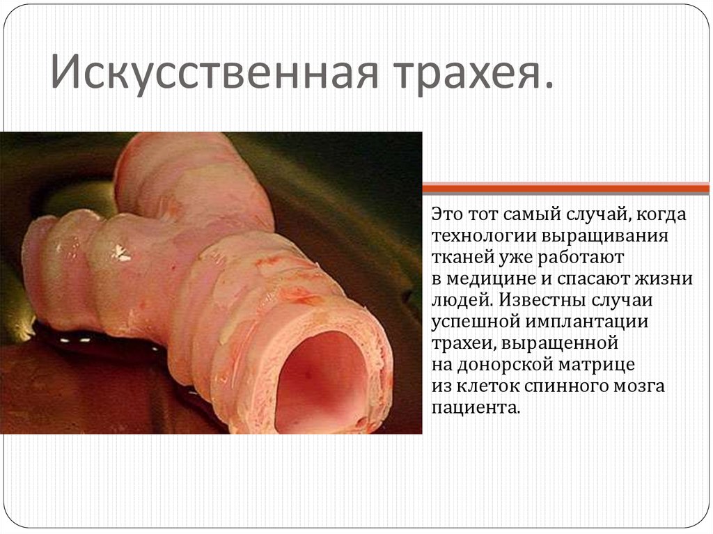 Искусственная трахея.