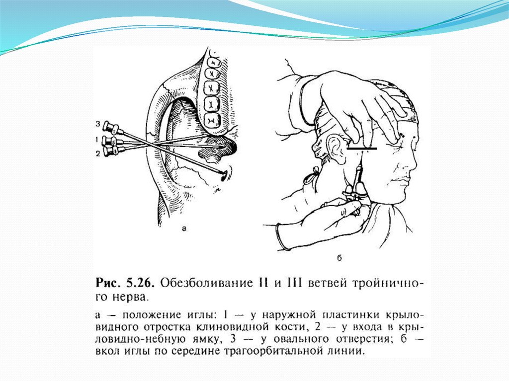 Блокада тройничного. Блокада 3 ветви тройничного нерва анестезия. Стволовые анестезии для отключения 2 ветви тройничного нерва. Стволовая анестезия Вайсблату. Стволовая анестезия подскуловой метод.