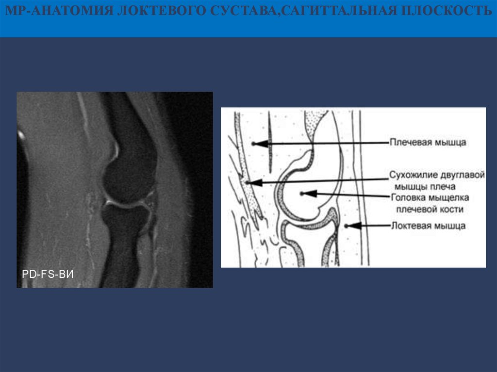 Мрт локтя. Анатомия локтевого сустава мрт. МР анатомия локтевого сустава. Анатомия локтевого сустава кт. Мышцы локтевого сустава мрт.