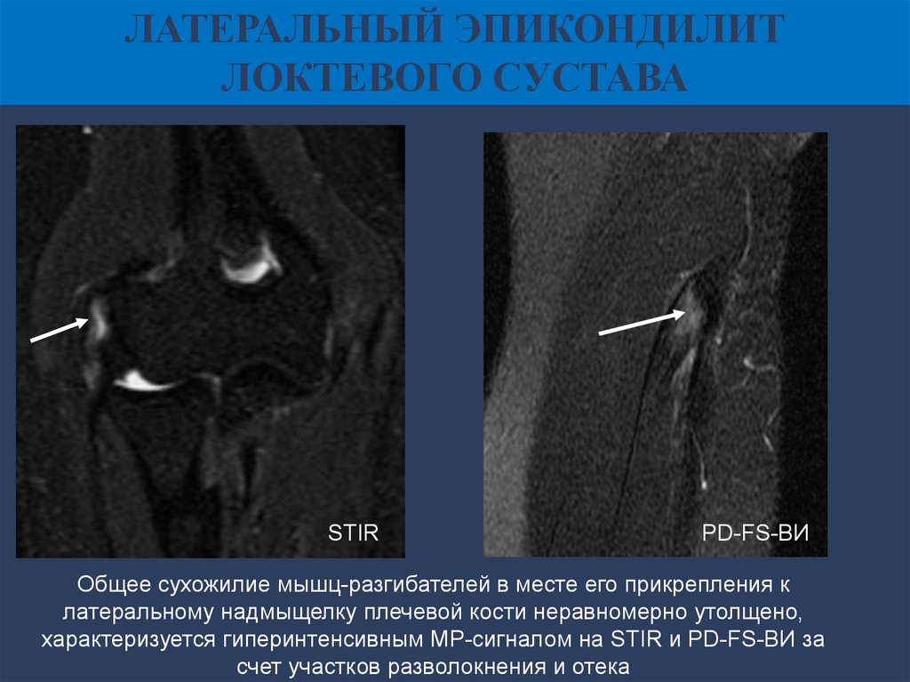 Латеральный эпикондилит. Латеральный эпикондилит локтевого сустава мрт. Эпикондилита локтевого сустава мрт. Эпикондилит медиальный локтевого рентген. Медиальный эпикондилит локтевого сустава рентген.