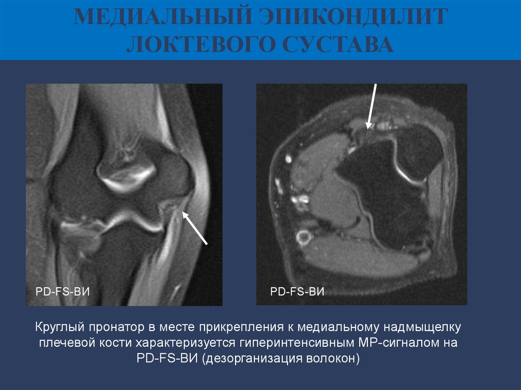 Медиальному надмыщелку кости