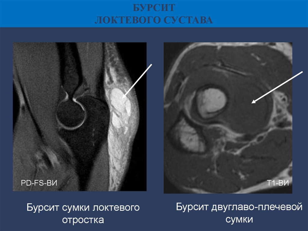 Мрт локтя. Препателлярный бурсит коленного сустава мрт. Бурсит локтевого сустава мрт. Синовиальные сумки локтевого сустава мрт. Бурсит локтевой сумки мрт.