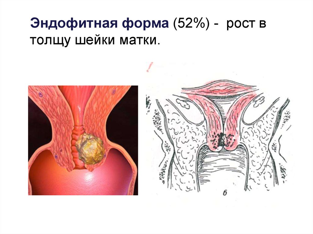 Рост рака. Экзофитная форма шейки матки. Эндофитная опухоль шейки матки.