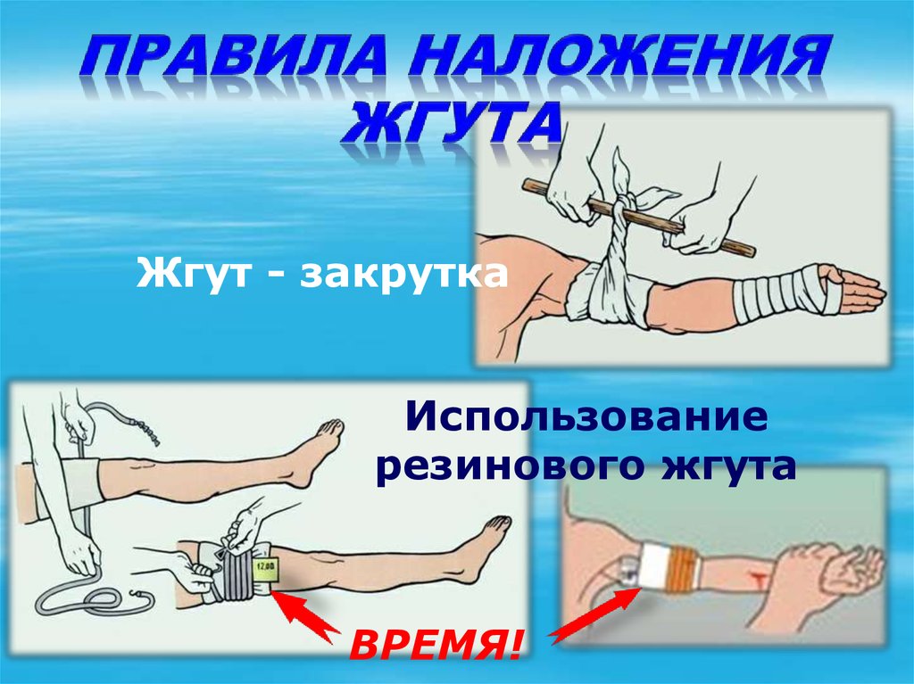 Правила наложения жгута