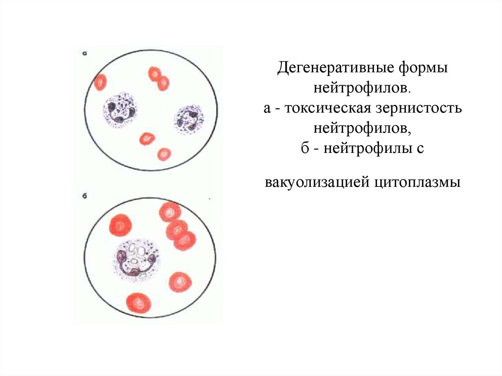 Токсогенная зернистость нейтрофилов