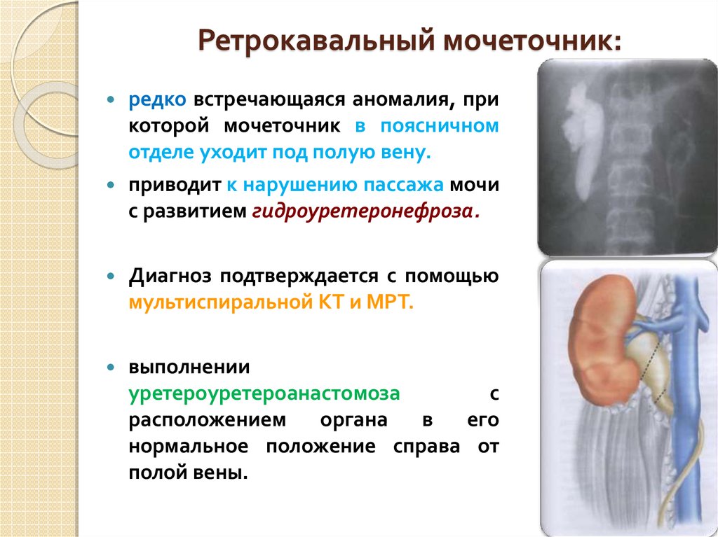 Аномалии мочеточников презентация