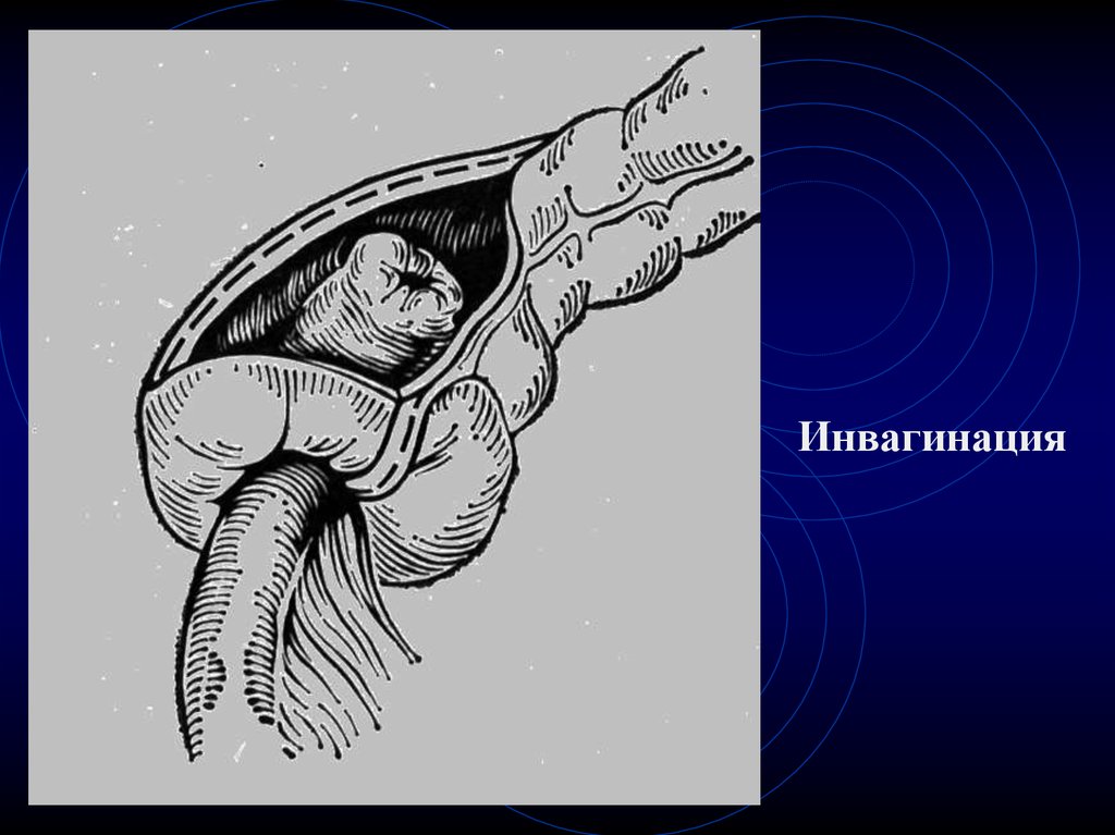 Инвагинация кишечника. Илеоцекальная инвагинация. Илеоцекальная инвагинация кишечника. Инвагинация непроходимость кишечника. Кишечная непроходимость инвагинация.