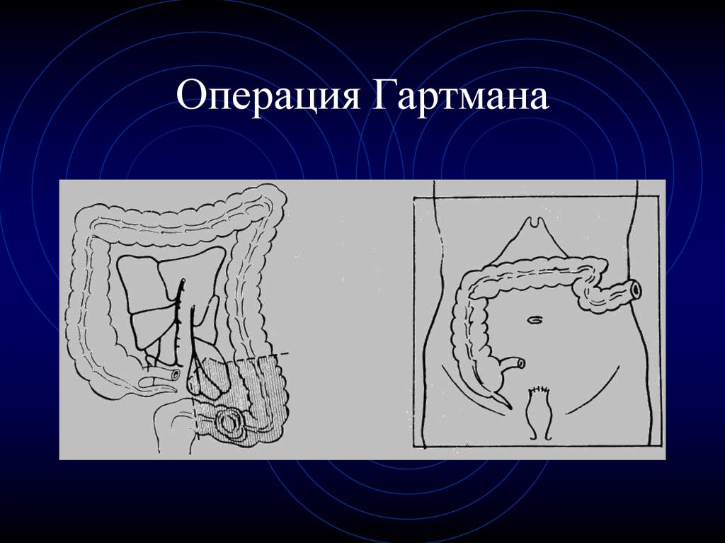 Что из себя представляет операция Гартмана?