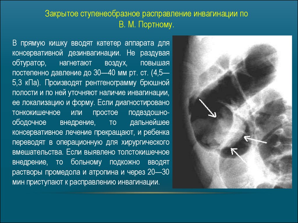 Инвагинация клиническая картина