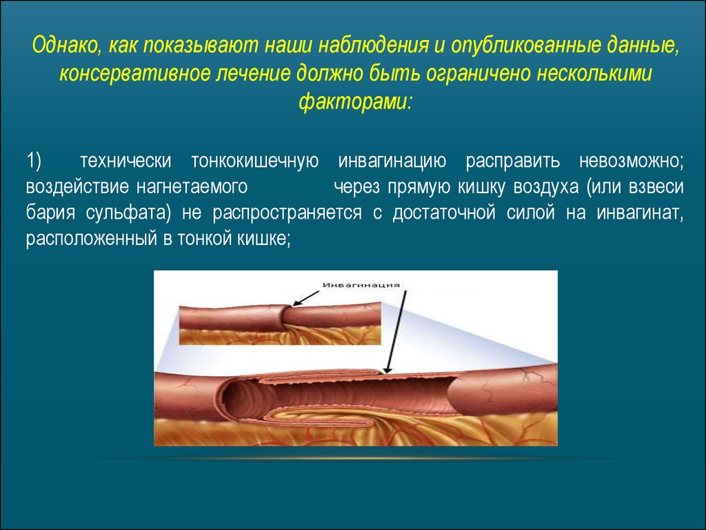 Инвагинация клиническая картина