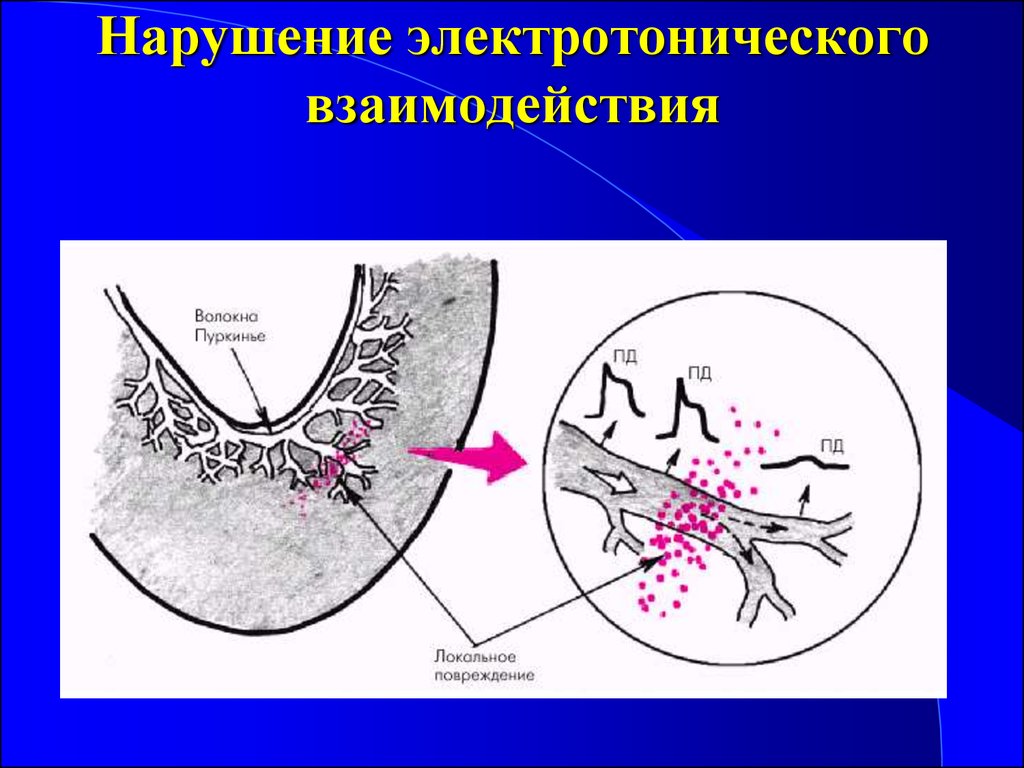 Нарушения проведения. Нарушение проведения импульса. Локальное повреждение это. Первичные Электротонические явления. Локальное органическое повреждение это.