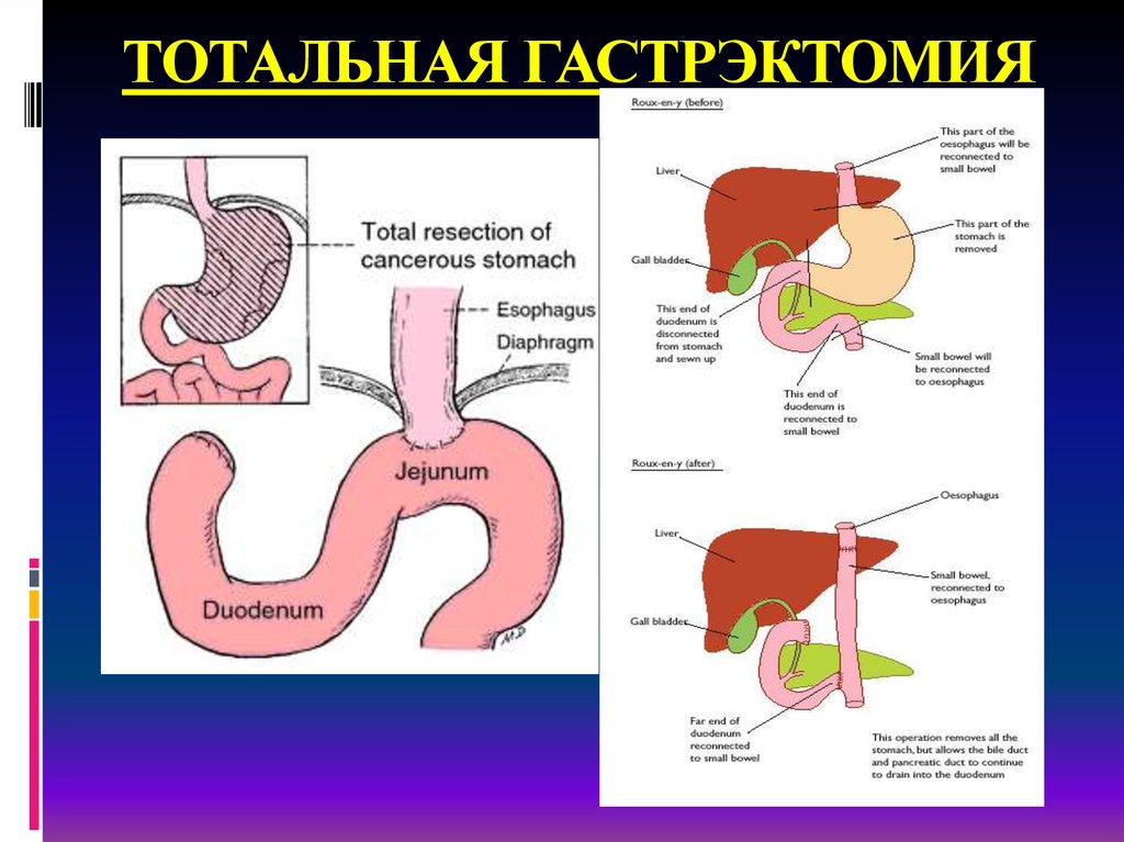 Резекция желудка схема