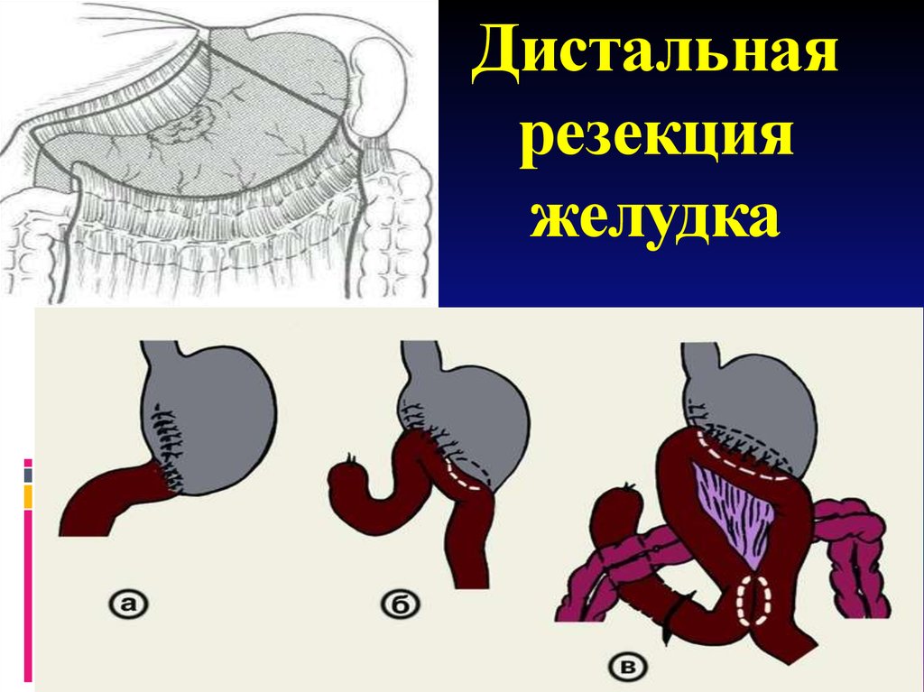 Резекция желудка. Дистальная и проксимальная субтотальная резекция желудка. Радикальная субтотальная резекция желудка. Проксимальная субтотальная резекция желудка схема. Субтотальная дистальная резекция желудка схема.