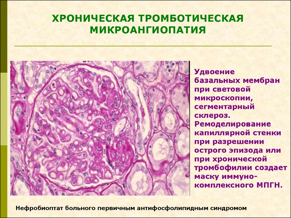 Микроангиопатия мозга. Микроангиопатия. Тромботическая микроангиопатия. Клинические проявления микроангиопатии. Мембранный гломерулонефрит.