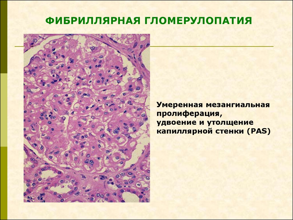 Презентация на тему гломерулонефрит