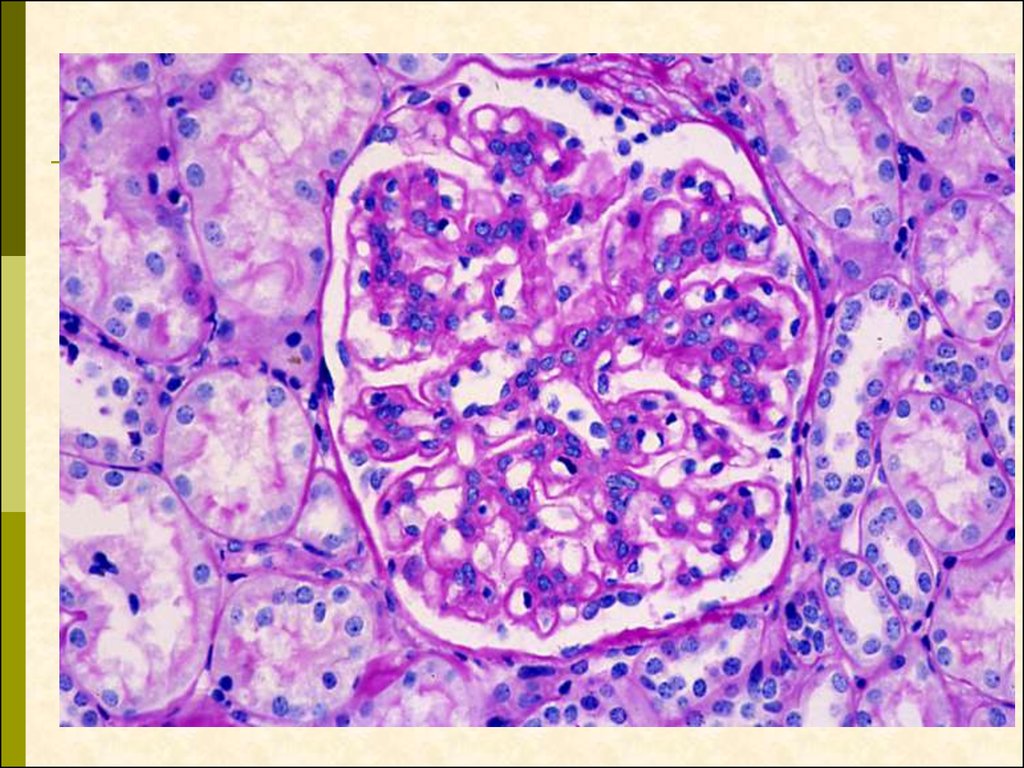 Морфологическая картина. Пролиферативный гломерулонефрит патанатомия. Скарлатинозный гломерулонефрит. Первичный гломерулонефрит. Первичный хронический гломерулонефрит.