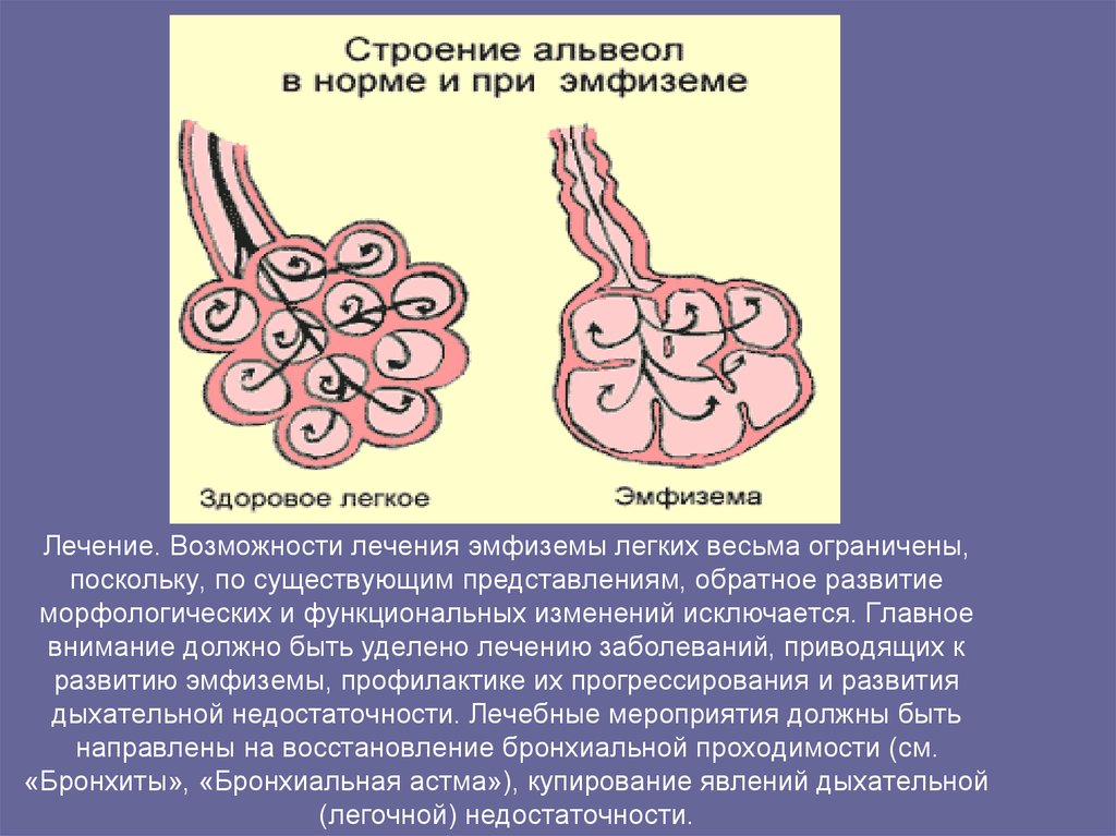 Эмфизема легких симптомы