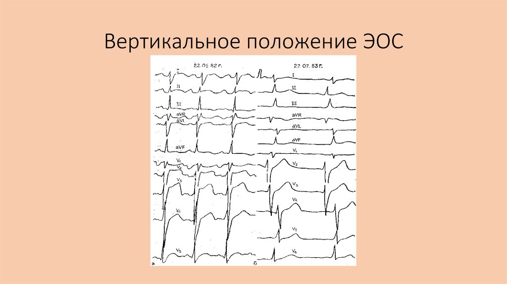 Экг вертикальное. ЭКГ вертикальное положение электрической оси. ЭКГ при вертикальной ЭОС.