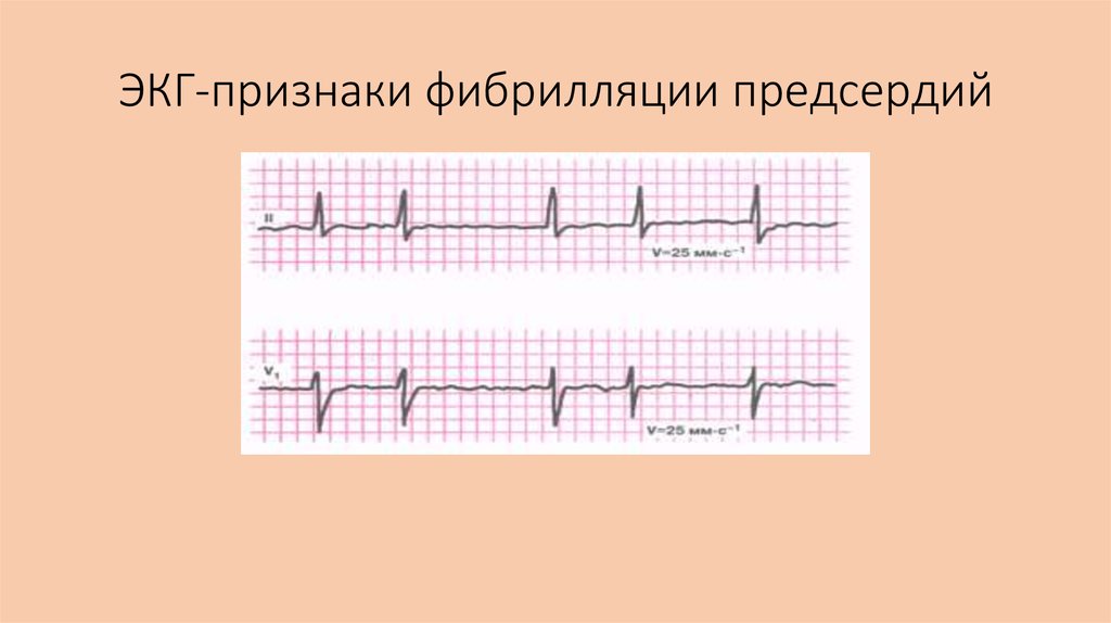 Волны при трепетании предсердий. ЭКГ при фибрилляции предсердий. Фибрилляция и трепетание предсердий на ЭКГ. Признаки трепетания на ЭКГ. ЭКГ при фибрилляции.