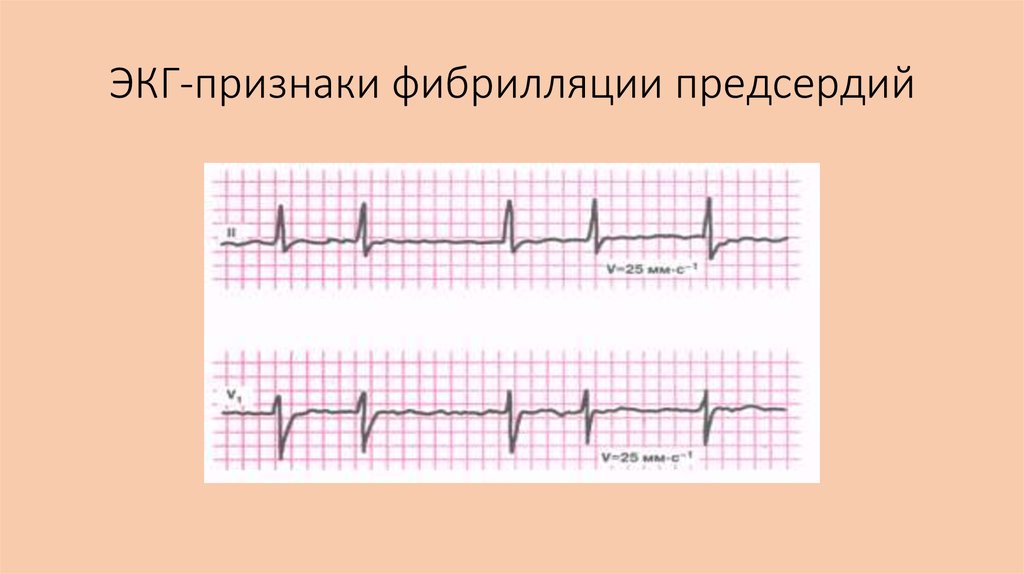 Фибрилляция на экг. Пароксизмальная фибрилляция предсердий на ЭКГ. ЭКГ при фибрилляции предсердий. Трепетание и фибрилляция предсердий на ЭКГ. ЭКГ критерии фибрилляция предсердий.