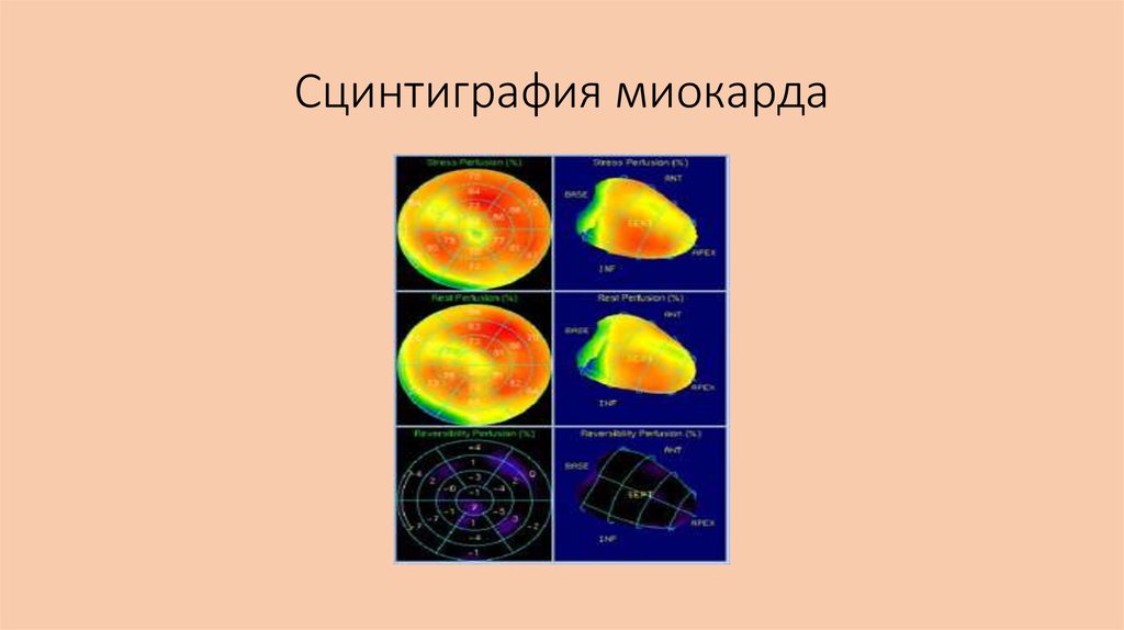 Сцинтиграфия миокарда. Сцинтиграфия очага инфаркта миокарда. Сцинтиграфия с ОФЭКТ кт инфаркт миокарда. Сцинтиграфия очага некроза миокарда. Сцинтиграфия миокарда с 99mtc-пирофосфатом.